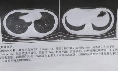 什么情况需要做肺部CT(做肺部ct要多少钱一次)