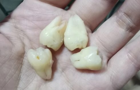 为什么有的牙齿有2个牙根有的没有(有两个牙根的是什么牙)